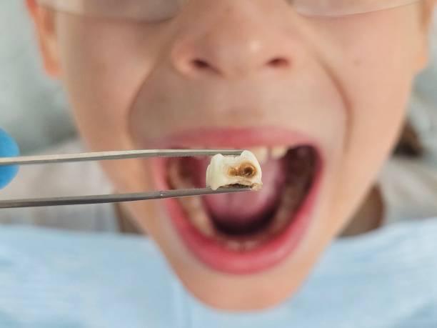 Best Emergency Treatment for Oral Infections in Addison, IL